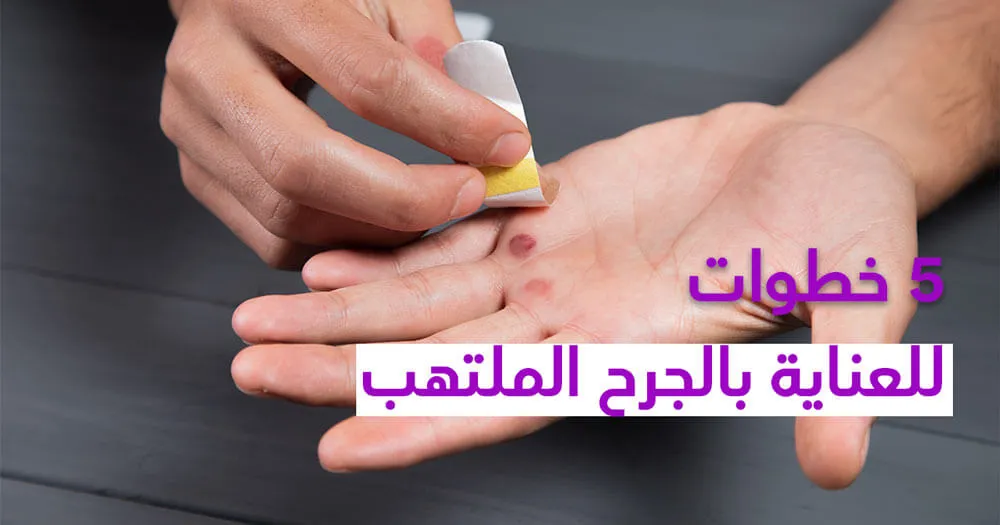  خطوات للعناية بالجرح الملتهب